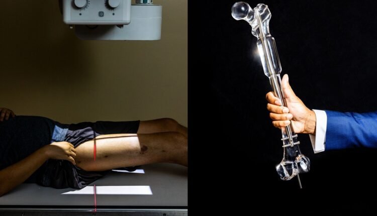 ‘Being short is a curse’: the men paying thousands to get their legs broken – and lengthened