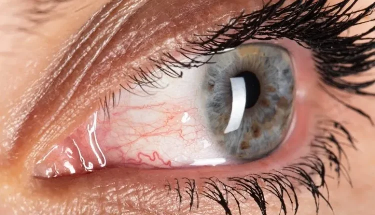 Νέα Ελπίδα για Σπάνια Οφθαλμολογική Πάθηση: Εγκρίθηκε η Πρώτη Θεραπεία Μετά από Πρωτοποριακές Κλινικές Δοκιμές