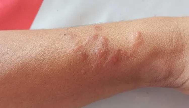 Αυτό το Παράσιτο Μπορεί να Απενεργοποιήσει τους Σημαντές Πόνου και Κνησμού σας