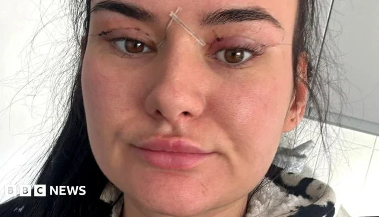 Blepharoplasty: Οι κίνδυνοι από τις φθηνές επεμβάσεις