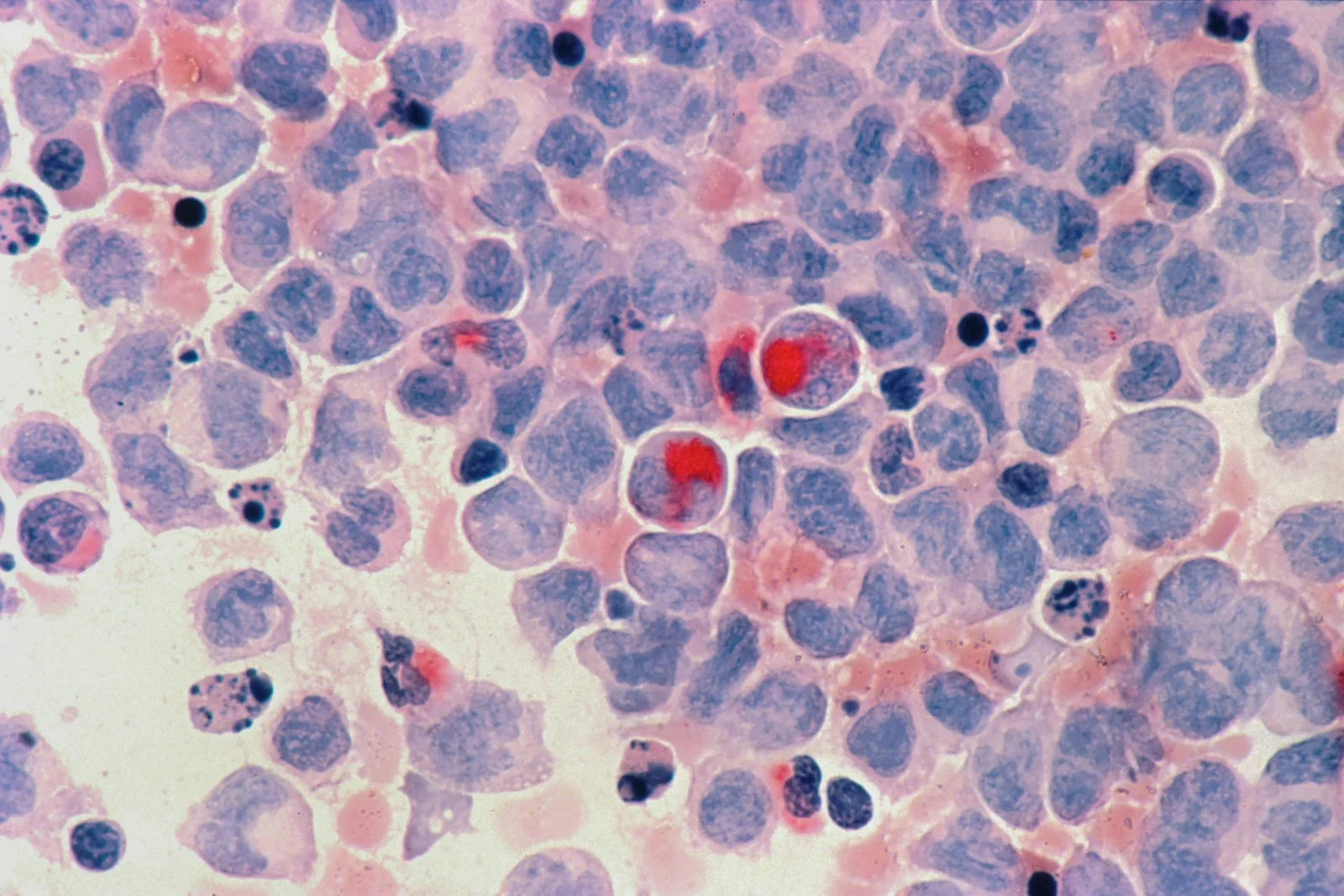 Microscopic view of stained cells with prominent red inclusions in a blue field